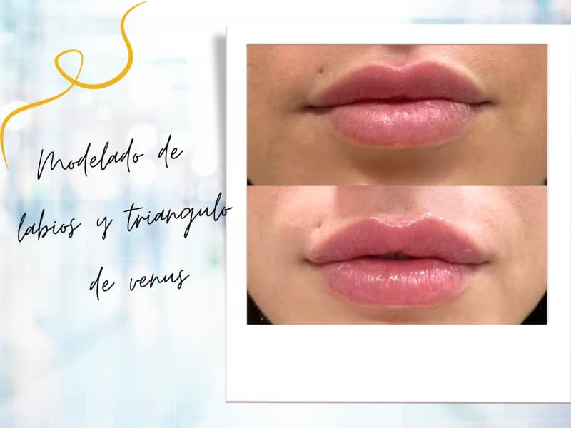 medicina estética relleno de labios